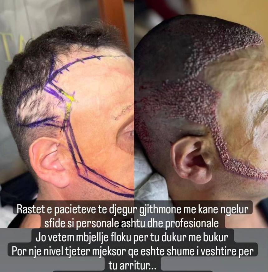Mbjellja e flokëve tek pacientë me lëkurë koke të djegur. Sfida e suksesshme e “International Hair Clinic's”. 2 09D6A959 5B92 4614 889F 9EF59EC44A73